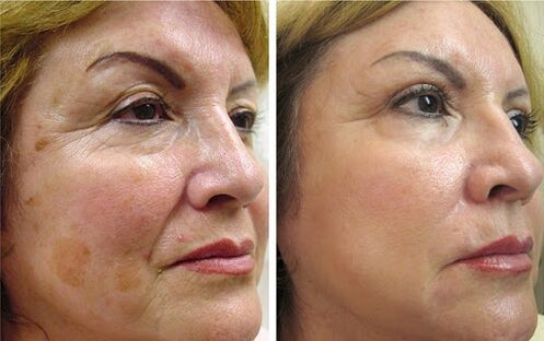 Anna from Wroclaw got a noticeable effect in smoothing wrinkles and tightening the contour of the face after using Canabilab