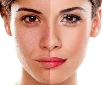 changes in facial skin after laser peeling
