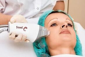 laser fractional rejuvenation of facial skin