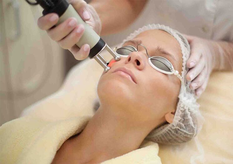 Laser procedure to rejuvenate the skin around the eyes