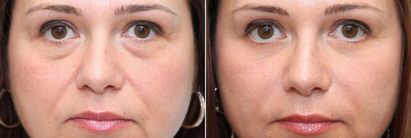 Before and after blepharoplasty - removal of the fatty body under the eyes and tightening of the skin