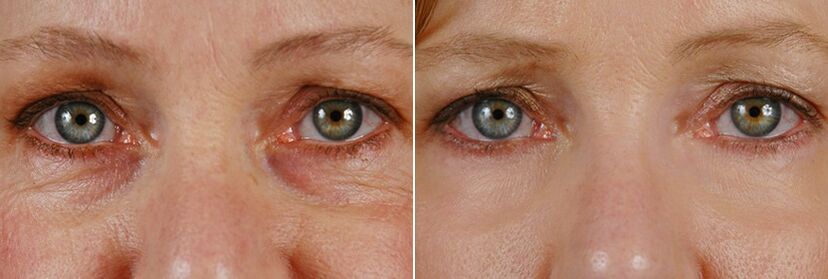 Before and after laser surgery - rejuvenation of the skin around the eyes