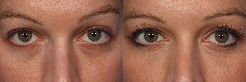 Before and after using injectable fillers - reduction of under-eye circles